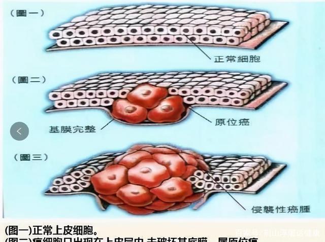 什么是原位癌？有什么？区分六种常见癌症表现，症状持续是关键。 