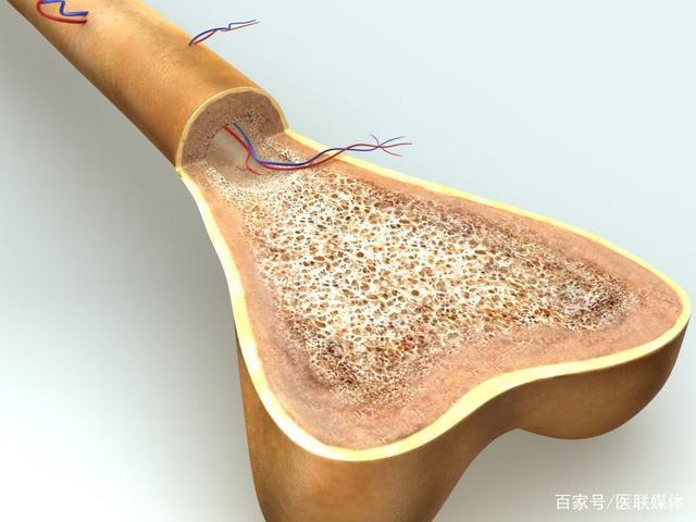 骨质疏松症容易骨折，年龄越大，必须改变这四个习惯。 