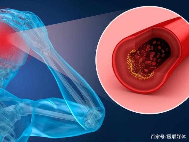 脑梗塞的“克星”有三个，一旦说出来，可能会恍然大悟。 