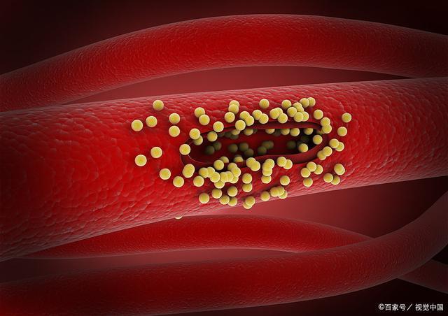 血管阻塞，很多健康问题或者上门，对血管无益的坏习惯要尽快改掉。 