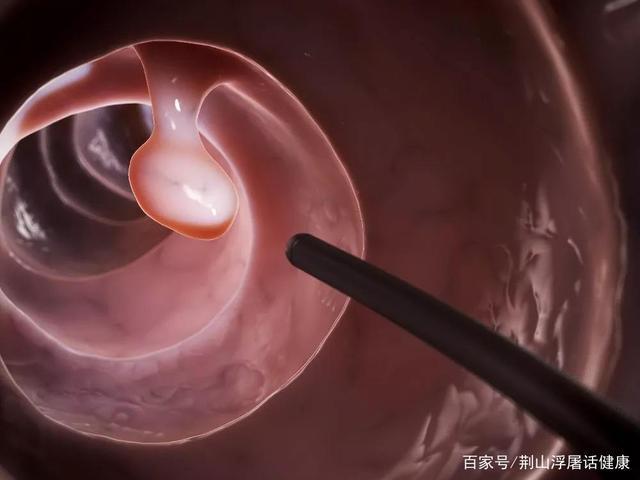 结肠镜检查有什么顾虑，能解决吗？检验报告，需要了解四个关键问题。 